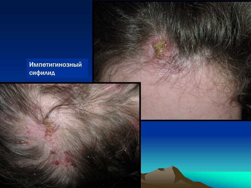 Импетигинозный сифилид